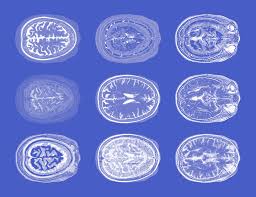 When Is A Headache A Sign Of A Brain Tumor Dana Farber