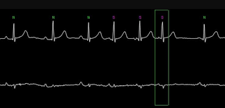 Image result for Extrasystole