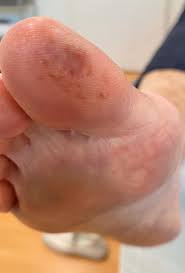 Image result for Chilblains