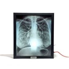 Mentalpieces X Ray Lightbox Internal Medicine Light Box Human Rib Cage X Ray