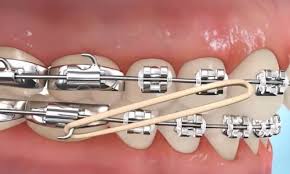 Why to use rubber bands with braces? How To Put Rubber Bands On Braces Premier Orthodontics