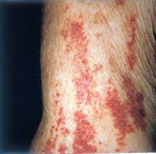 In older adults, this type of bleeding is called senile purpura. Purpura And Other Hematovascular Disorders Sciencedirect