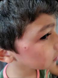 Can someone safely remove the wasp or hornet nest?