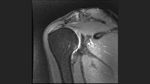 Image result for Rotator Cuff Injury