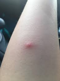 If you have the following however, if you were bitten by one of the two venomous spiders that reside in the us, you may experience additional symptoms that are typically. Does This Look Like A Spider Bite Itchy And Showed Up 2 Days Ago On My Arm Askdoctorsmeeee
