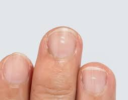 White Spots On Nails: Causes, Prevention, And Treatment