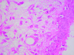 The world health organization (who) has classified pts histologically as benign, borderline, and malignant. Optimising Preoperative Diagnosis In Phyllodes Tumour Of The Breast Journal Of Clinical Pathology
