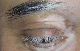 It grows really, really fast and is always on the same spot. Poliosis Causes Symptoms And Treatment