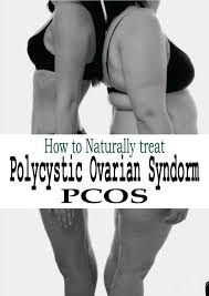 How To Naturally Treat Polycystic Ovarian Syndorm Pcos Pcos Awareness Pcos Pcos Diet