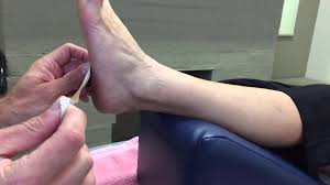 Cuboid Sling Taping Cuboid Syndrome Cuboid Foot Injury