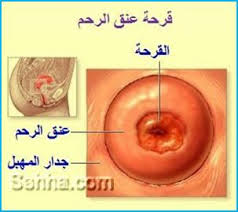 ملف كامل عن الإلتهابات المهبلية ريموووو