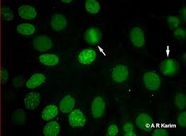 Image result for ANA Staining Pattern
