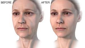 Morpheus8 for smaller treatment areas and morpheus8 body for larger and deeper tissue treatments. Combination Treatments La Longevity