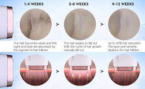 In this regard, why is my hair not falling out after laser? Ipl Hair Removal Device For Men Women Imene Home Use 50000 Light Pulses Laser Hair Remover Slide Flash Ice Cooling Function Permanent Hair Removal For Body Intimate Area Armpits Legs Amazon De
