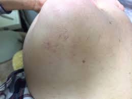 Firstly, it is worth understanding that laser and electrolysis treatments are some of the most commonly used means of removing hairs. Pcos Facial Hair Electrolysis How I Deal With It Hirsutism My Pcos Kitchen