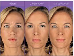 Botox ® cosmetic may cause serious side effects that can be life threatening. Kybella Toronto Juvederm Toronto Botox And Juvederm Fillers