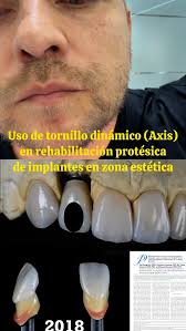 Caso clínico en zona estética con implantes 👨‍⚕️ 🔩 🦷 , En este caso  clínico demostramos cómo un aditamento sencillo como el tornillo dinámico  (Axis) puede marcar la diferencia:, ✅ Resolvió un problema ...