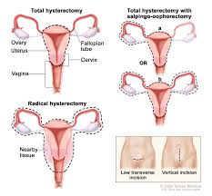 After a woman's periods have stopped, vaginal bleeding could be a sign of a health issue—including endometrial (uterine) cancer. Ovarian Germ Cell Tumors Treatment Pdq Pdq Cancer Information Summaries Ncbi Bookshelf