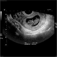 Gestalt psychology (also known as gestalt theory), a theory of mind and brain, describing the gestalt effect. Live Intrauterine Gestation Radiology Case Radiopaedia Org