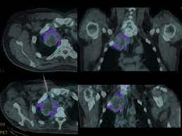 Maybe you would like to learn more about one of these? A 54 Year Old Patient With Right Sided Sarcomatoid Mesothelioma Download Scientific Diagram