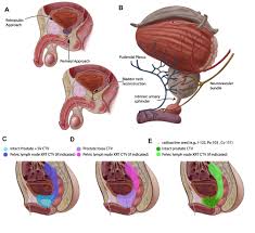 Urinary symptoms also can be caused by an infection of the bladder or other conditions. The Impact Of Prostate Cancer Treatment On Quality Of Life A Narrativ Rru