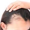 It is a common misconception that wearing a hat strains hair follicles, causing hair loss. 3