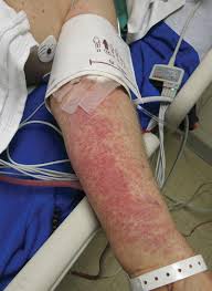 Solar purpura is a harmless condition and is. Petechiae And Ecchymoses On The Arm Mdedge Dermatology