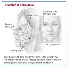 Get important bell's palsy facts and information you might not know, including what bell's palsy is, common bell's palsy causes, and available bell's palsy treatment. Bell S Palsy Overview Harvard Health