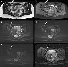 Ct and ultrasound are more preferable for getting an overall view of the gastric wall and. Abdominal Wall Endometriosis Awe In A 31 Year Old Woman Without A Download Scientific Diagram