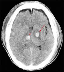 Image result for Diffuse Axonal Injury