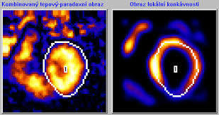 Image result for Nuclear Ventriculogram