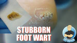 It takes several months depending on how large they are but i have tried this and it works on plantars the size. How To Treat Difficult Plantar Warts Removal Foot Health Month 2018 9 Youtube