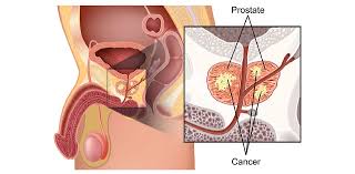 We did not find results for: Kanker Prostat Ahcc