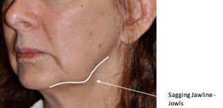 While there has long been a lack in confidence in the treatments used to tighten saggy jowls, we're proud to be one of the only providers in the state of alabama to offer a new innovative, nonsurgical procedure called profound. Jowls Sagging Jawline Contour Definition Fillers Ellanse