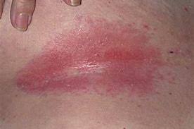 Some people find relief with a vinegar treatment for intertrigo. For Your South West Scotland Breast Screening Facebook