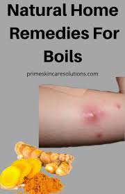 Natural Home Remedies For Boils In 2020 Home Remedy For Boils Natural Home Remedies Home Remedies For Skin