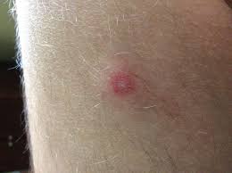 Their bite can tear the skin and cause pain, redness, and swelling. Mice Insect Bite With White Center