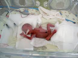 See all related lists ». Low Birth Weight Wikipedia