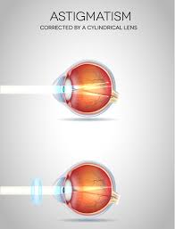 Most eye doctors agree that toric contact lenses are the best lenses for people with astigmatism. What Are Toric Contact Lenses Astigmatism Eye Health Central