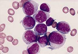 La leucemia mieloide aguda (también conocida como leucemia mieloblástica aguda, leucemia mielógena aguda, leucemia granulocítica aguda o lma) es el tipo más común de leucemia aguda en adultos. Signos Y Sintomas De La Leucemia Mieloide Aguda
