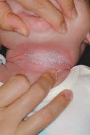 Intertrigo is irritant dermatitis, usually found in skin folds, that is caused by rubbing, increased temperature, and moisture. Dermhelpcentral Intertrigo In Babies