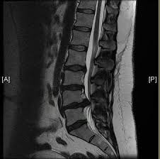 Orthobullets Cauda Equina Syndrome Is A Condition Facebook