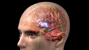 Deep Brain Stimulation Surgery for Parkinson's Patient