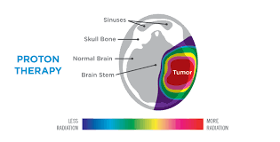 Radiation therapy is a common treatment for several types of cancer. Proton Therapy Advanced Radiation Therapy Treatment Provision