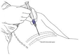 Image result for Intrapleural Anesthesia