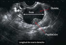 Quistes De Ovario Funcionales O Neoplasicos Benignos O Malignos