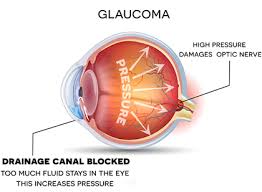 The main sign is a cloudy cornea. Glaucoma Honolulu Glaucoma Treatment Kailua Kona Eye Exams
