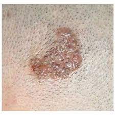 It tends to appear on the scalp, face and ears. Pdf Basal Cell Carcinoma In A Child