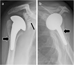 Image result for Shoulder Imaging