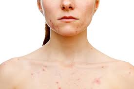 While the citric acid in lemon lighten the acne scars on back, the alpha hydroxy acids (aha) in it help remove dead skin cells as well help in the development of new cells grow. Chest Acne What Causes It And How To Get Rid Of It The Healthy